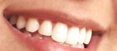 implantes-dentarios-sao-jose-de-ribamar-1380113045